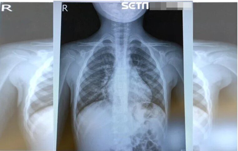 Virus HMPV tấn công Trung Quốc, bác sĩ kêu gọi làm ngay 2 việc