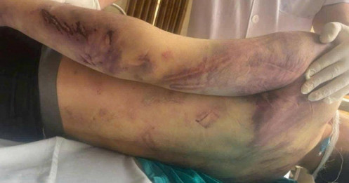 Bộ Y tế chỉ đạo 'nóng' sau vụ học viên Trung tâm CTXH Hải Hà tử vong