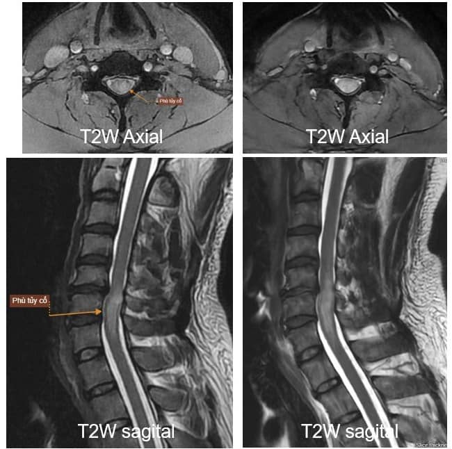 Bệnh viện Mặt Trời phẫu thuật thành công ca u nội tủy cột sống hiếm gặp